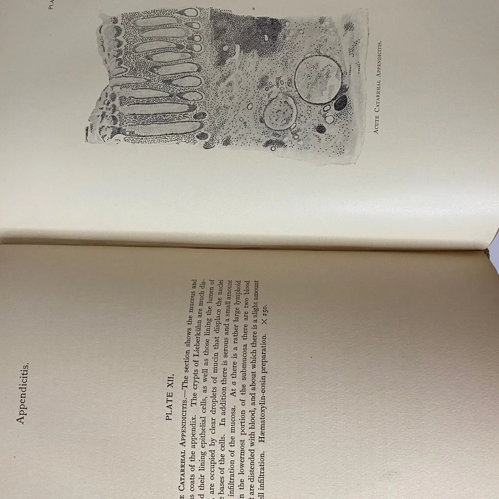 1905 Appendicitis Diagnosis Treatment John‎ B Deaver 3rd Ed Medical History Book